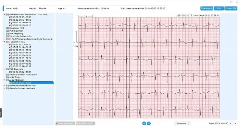 viatom-er1-lw-24-oras-ekg-holter-rogzito-mobil-ekg-holter-elektrokardiogram